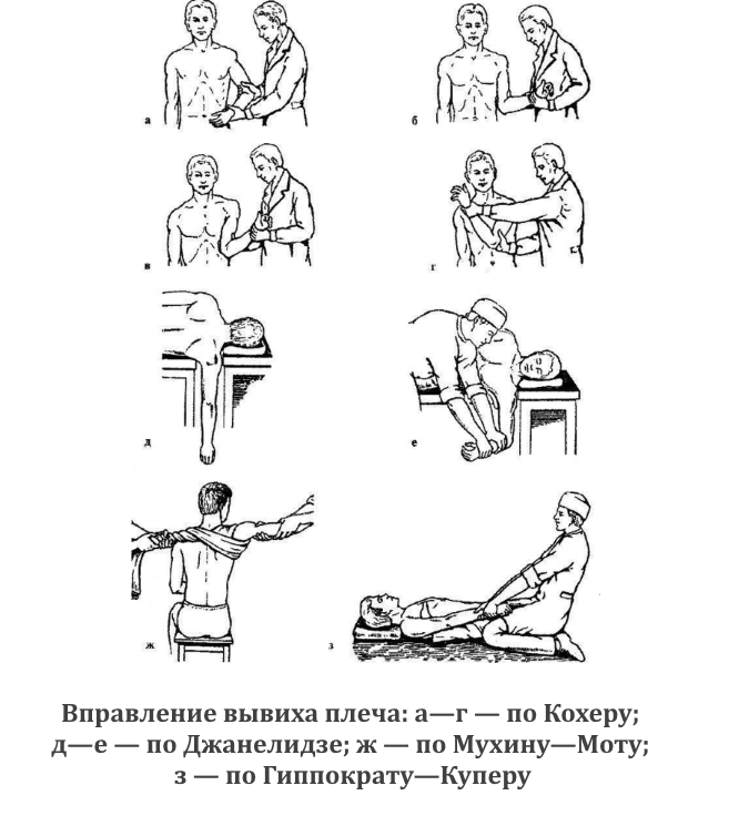 Виды вправления вывиха плеча Виды вправления вывиха плеча