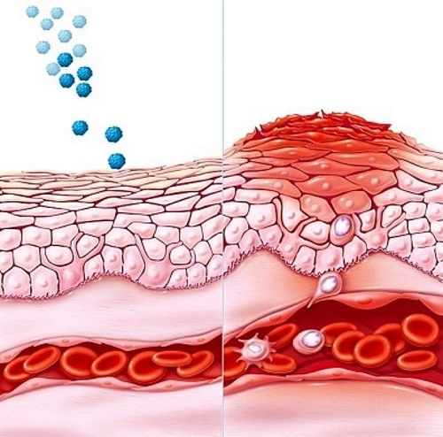 Выработка антител при аллергии Выработка антител при аллергии