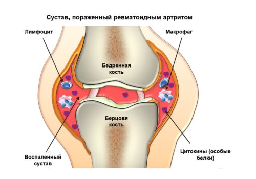 Артрит колена Артрит колена