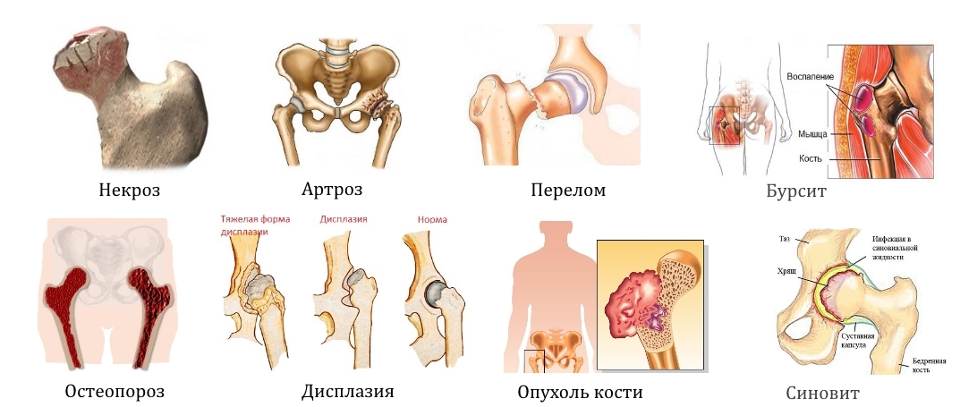Заболевания и травмы тазобедренного сустава Заболевания и травмы тазобедренного сустава