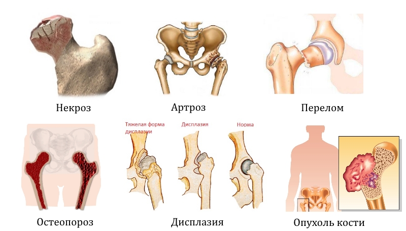 Заболевания и травмы тазобедренного сустава Заболевания и травмы тазобедренного сустава