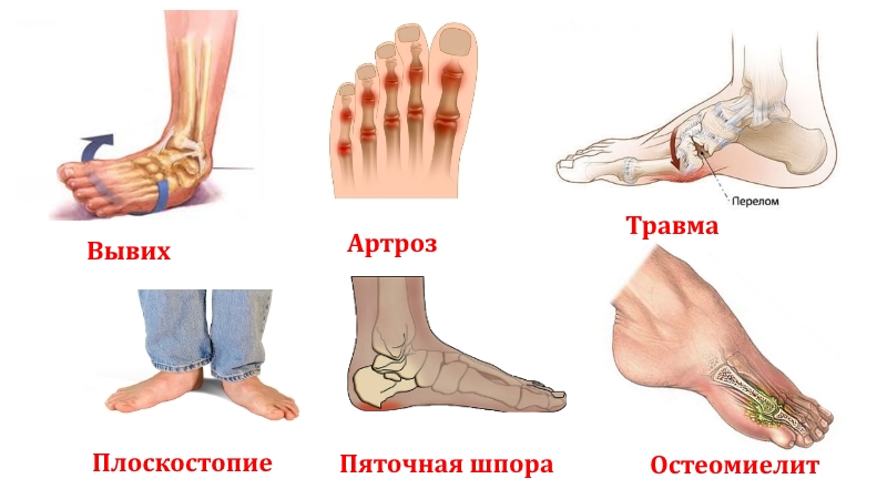 Заболевания костей и травмы стопы Заболевания костей и травмы стопы