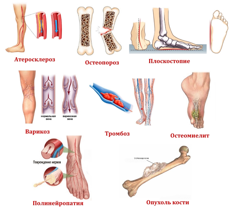 Заболевания нижних конечностей Заболевания нижних конечностей