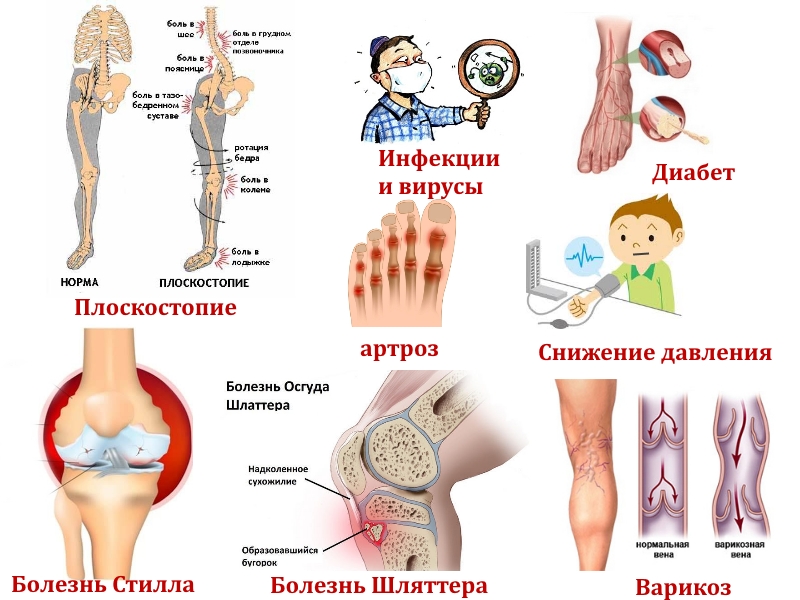 Заболевания ног у детей Заболевания ног у детей