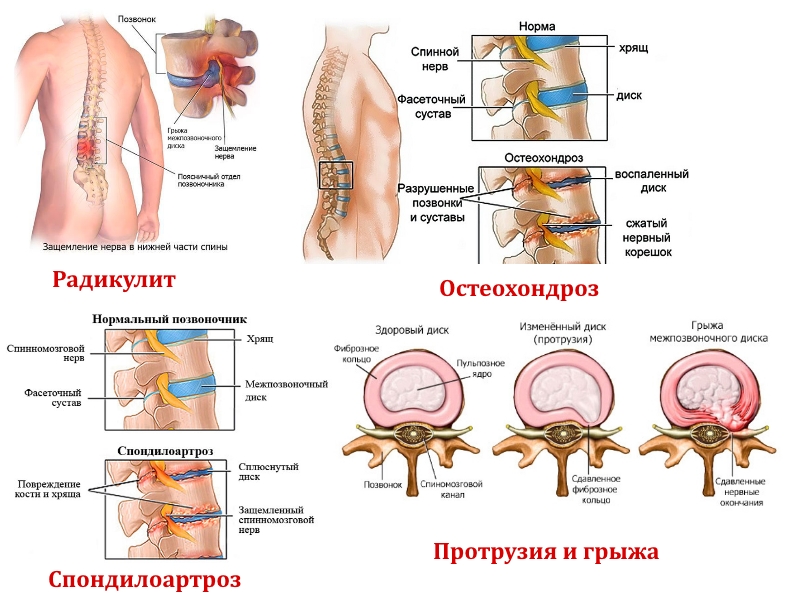Заболевания поясничного отдела Заболевания поясничного отдела