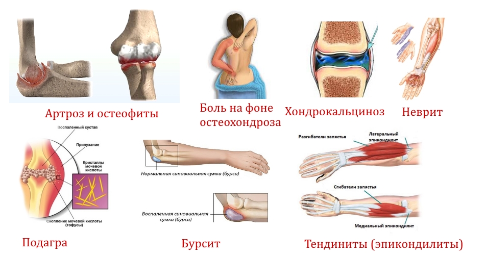 Заболевания — причины боли в локте Заболевания — причины боли в локте