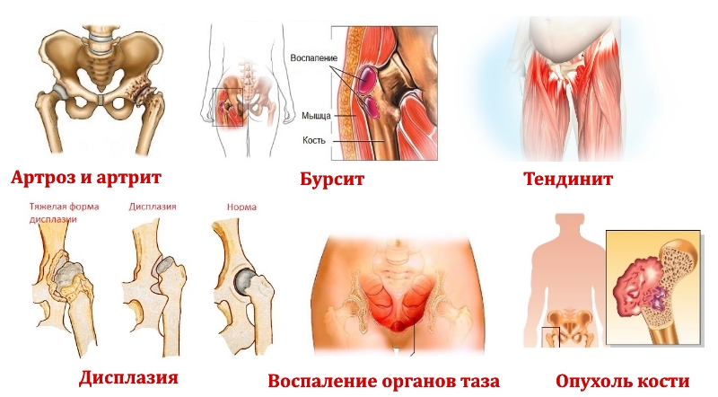 Заболевания — причины боли в области таза и ног Заболевания — причины боли в области таза и ног