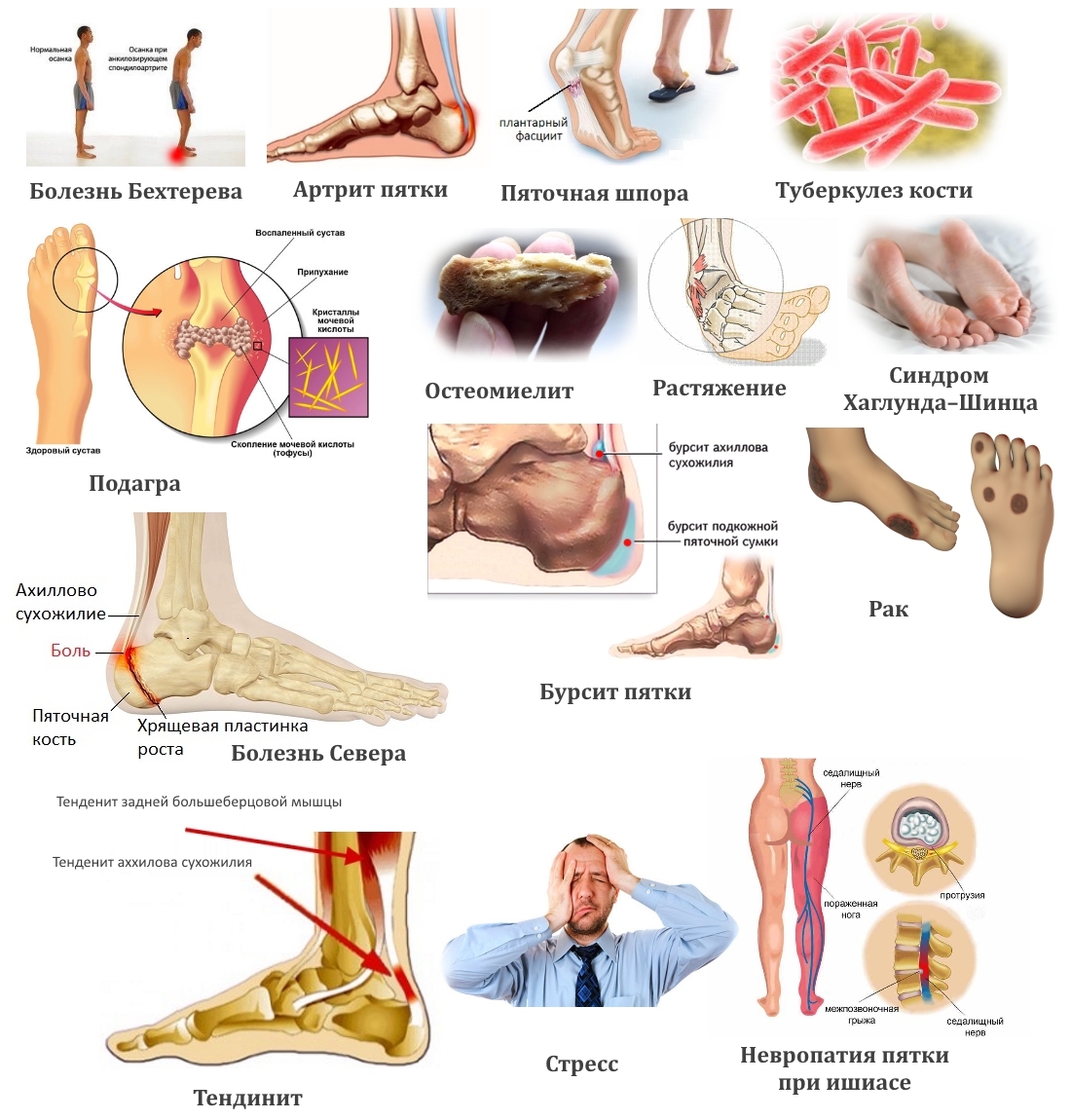 Заболевания — причины боли в пятке Заболевания — причины боли в пятке