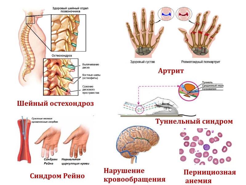 Заболевания — причины онемения Заболевания — причины онемения