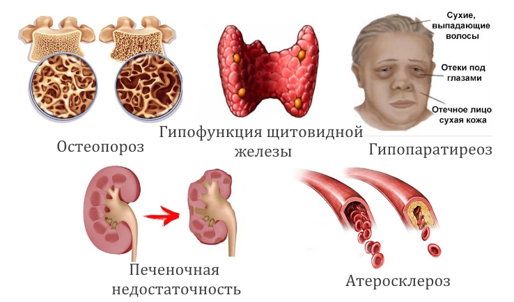 Заболевания — причины пониженного остеокальцина Заболевания — причины пониженного остеокальцина
