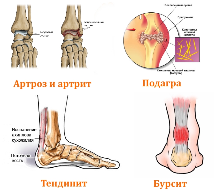 Заболевания щиколотки Заболевания щиколотки