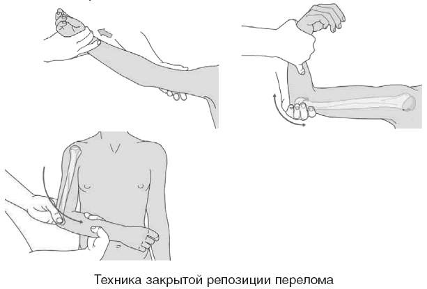 Закрытая репозиция перелома предплечья