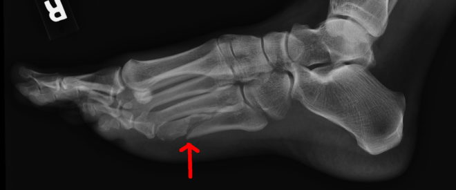 Закрытый перелом пятой плюсневой кости Закрытый перелом пятой плюсневой кости