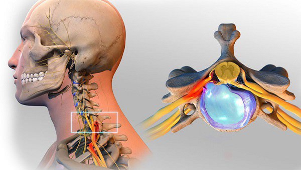 Защемление нерва в шейном отделе при грыже Защемление нерва в шейном отделе при грыже