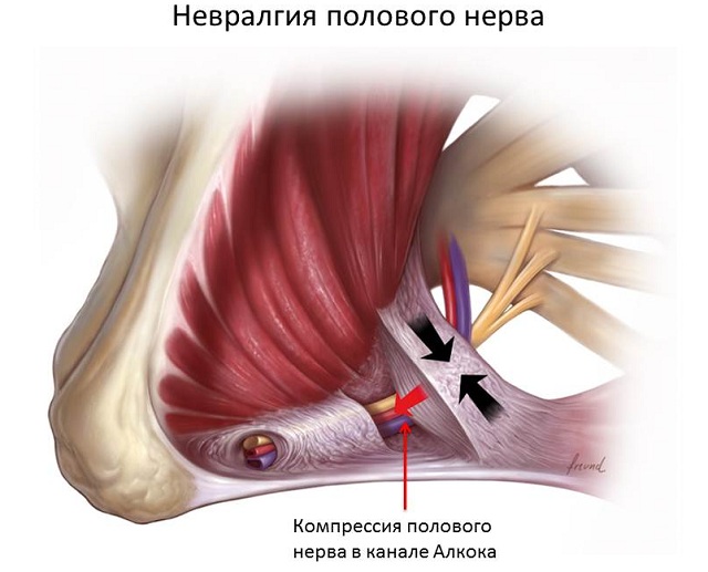 Паховое защемление полового нерва у мужчин Паховое защемление полового нерва у мужчин