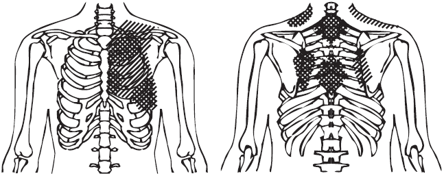 Зоны распространения боли при вертеброгенной торакалгии Зоны распространения боли при вертеброгенной торакалгии