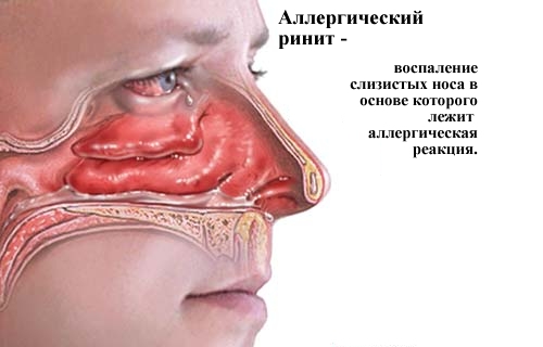 Аллергический ринит
