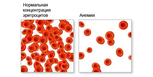 Возникновение анемии