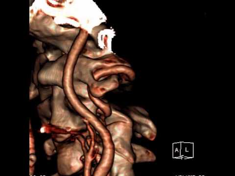 Аномалия Киммерли на КТ Аномалия Киммерли на КТ