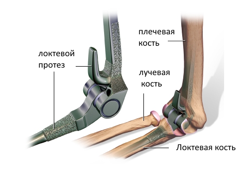 Схема эндопротезирования локтевого сустава Схема эндопротезирования локтевого сустава