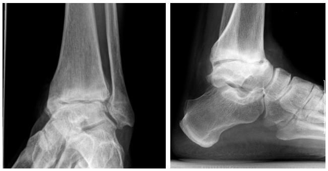 Артрит голеностопа на рентгене Артрит голеностопа на рентгене