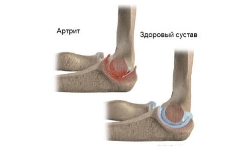 Артрит локтевого сустава Артрит локтевого сустава