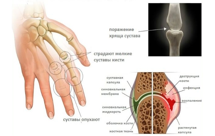 Изменения при артрите пальцев рук Изменения при артрите пальцев рук