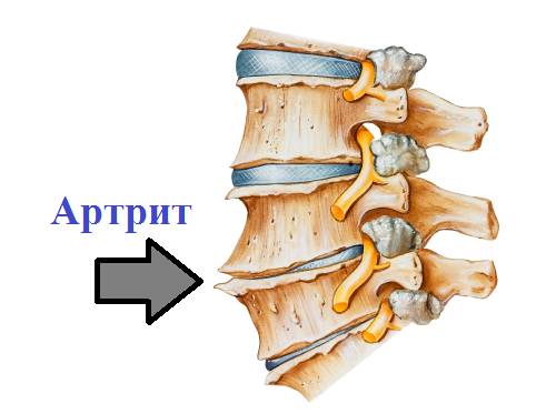 Артрит позвоночника Артрит позвоночника