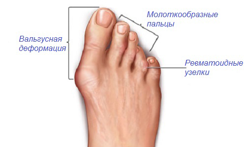 Артрит стопы Артрит стопы