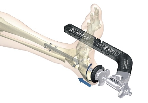 Артродез голеностопного сустава Артродез голеностопного сустава