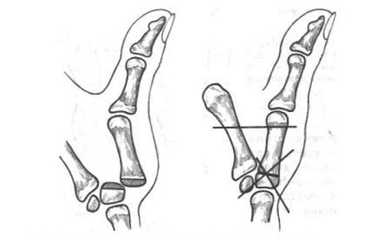 Артродез пальца Артродез пальца