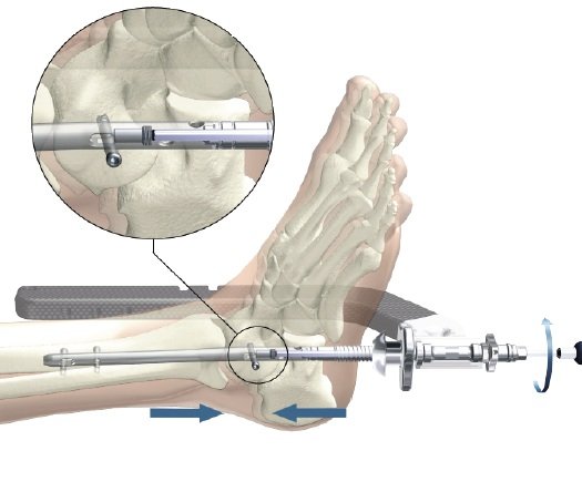 Артродез Артродез