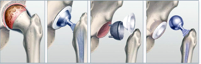 Артропластика тазобедренного сустава Артропластика тазобедренного сустава