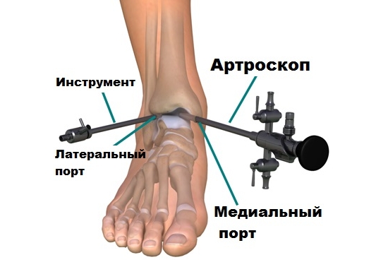 Артроскопия голеностопа Артроскопия голеностопа