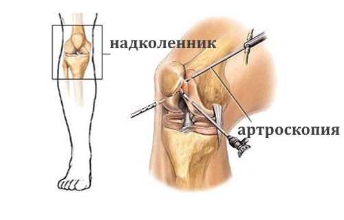 Артроскопия при вывихе надколенника