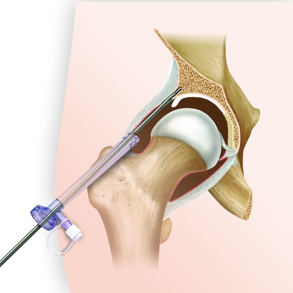 Артроскопия тазобедренного сустава Артроскопия тазобедренного сустава