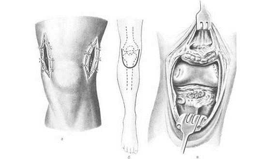 Операция артротомия Операция артротомия