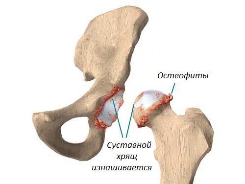 Остеофиты вследствие артроза Остеофиты вследствие артроза