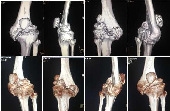 Артроз колена на КТ мониторе Артроз колена на КТ мониторе