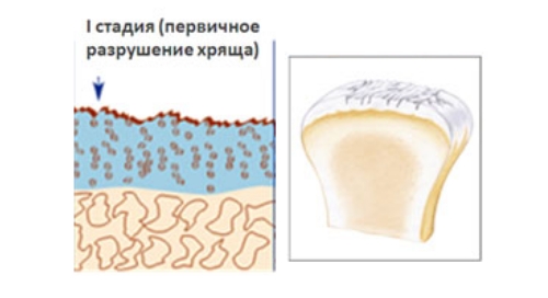 Артроз локтевого сустава первой степени Артроз локтевого сустава первой степени