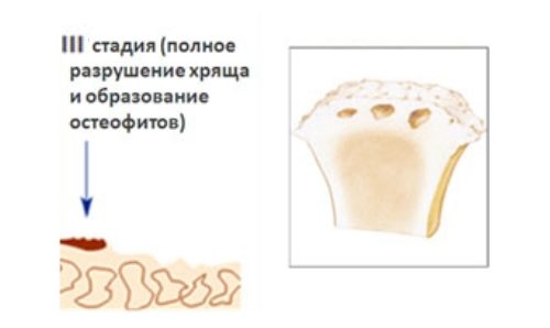 Артроз локтевого сустава третьей степени Артроз локтевого сустава третьей степени