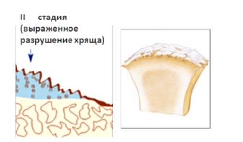 Артроз локтевого сустава второй степени Артроз локтевого сустава второй степени