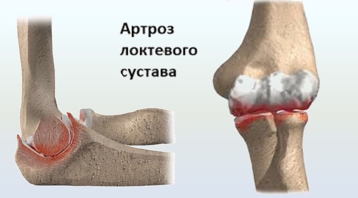 Артроз локтевого сустава Артроз локтевого сустава