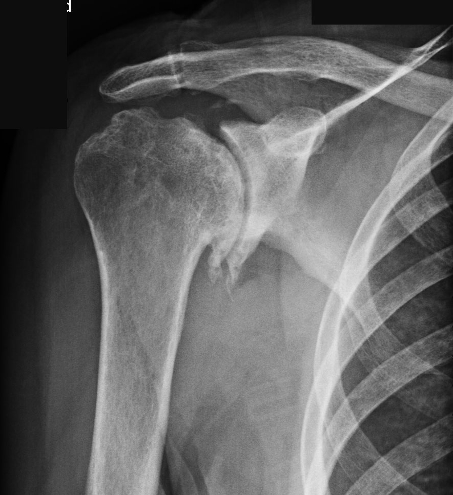 Артроз плечевого сустава на рентген снимке Артроз плечевого сустава на рентген снимке