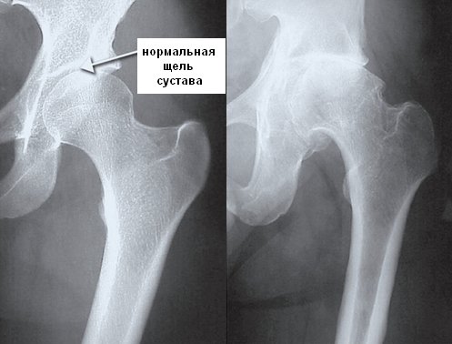 Артроз тазобедренного сустава на рентгене Артроз тазобедренного сустава на рентгене