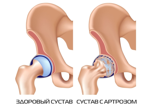 Артроз тазобедренных суставов Артроз тазобедренных суставов