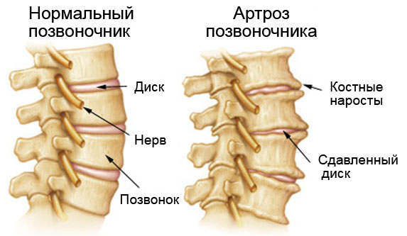 Схема артроза позвоночника Схема артроза позвоночника