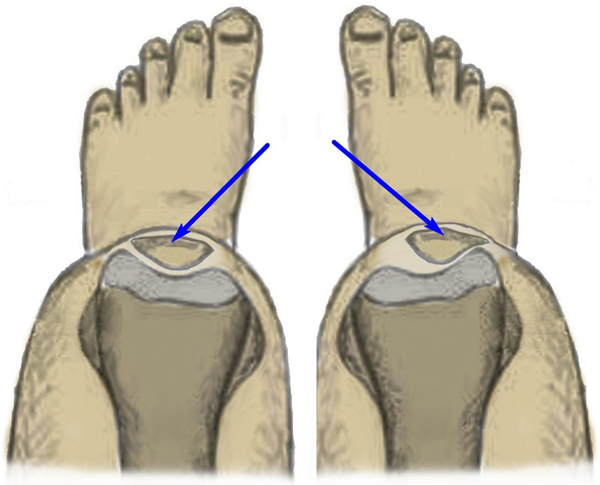Асимметрия положения надколенников Асимметрия положения надколенников