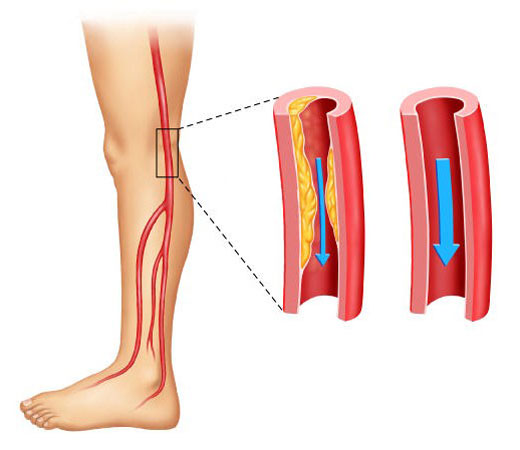 Атеросклероз сосудов ног Атеросклероз сосудов ног