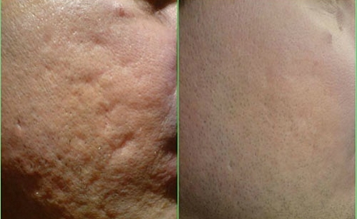 Бадяга от рубцов и постакне Бадяга от рубцов и постакне